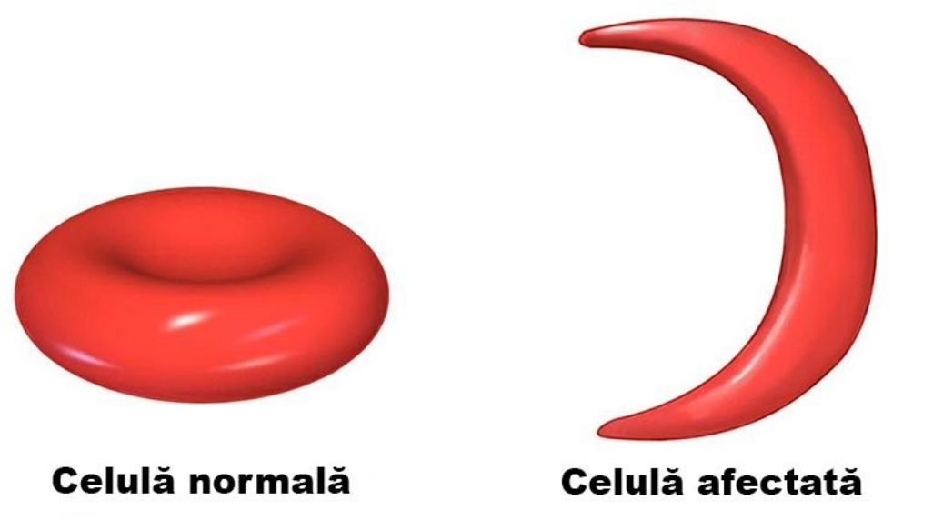 Anemia falciforma in timpul sarcinii
