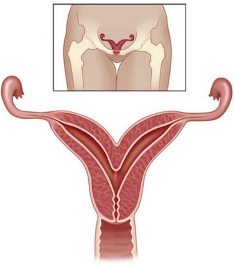 Anomalii uterine