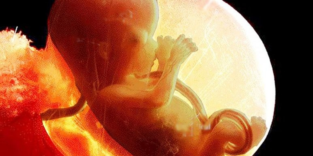 Embolia cu lichid amniotic