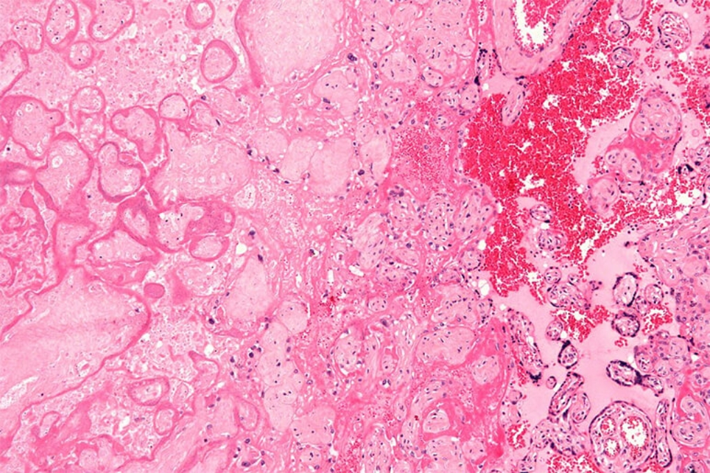 Hipoxia intrauterina